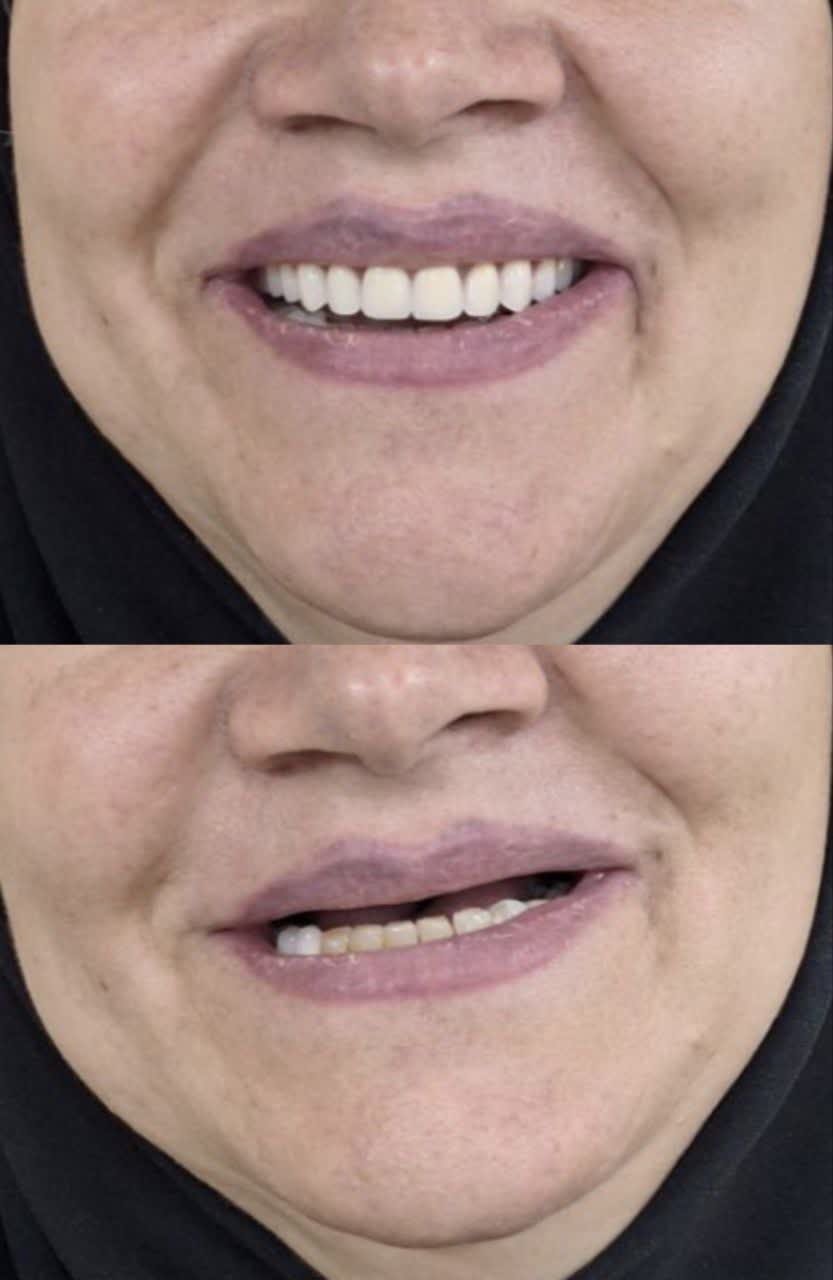 گالری لابراتوار دندانسازی .ساخت دندان مصنوعی تک واحدی ،چند واحدی و دست کامل