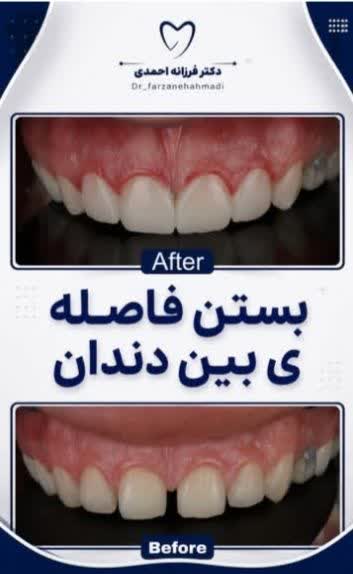 بستن فاصله دندانها