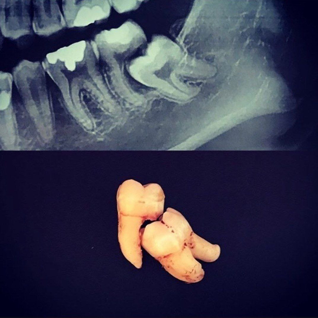 کشیدن دندان خلفی