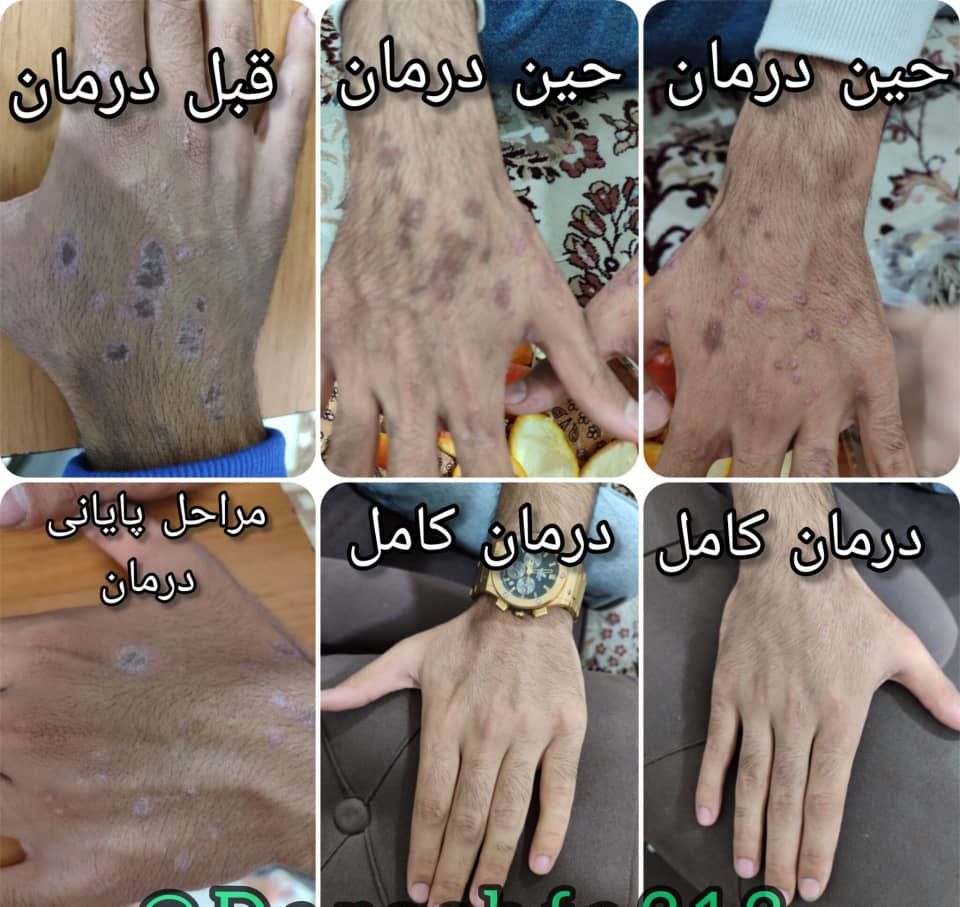 بیشتر از هزار مورد بهبودی مشکلات پوستی 