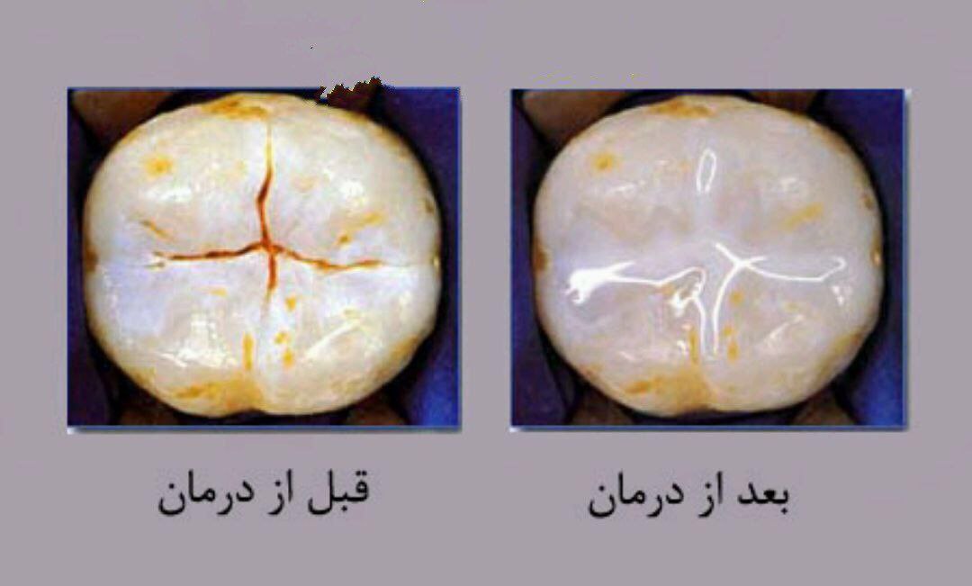 آمالگام دو سطحی
