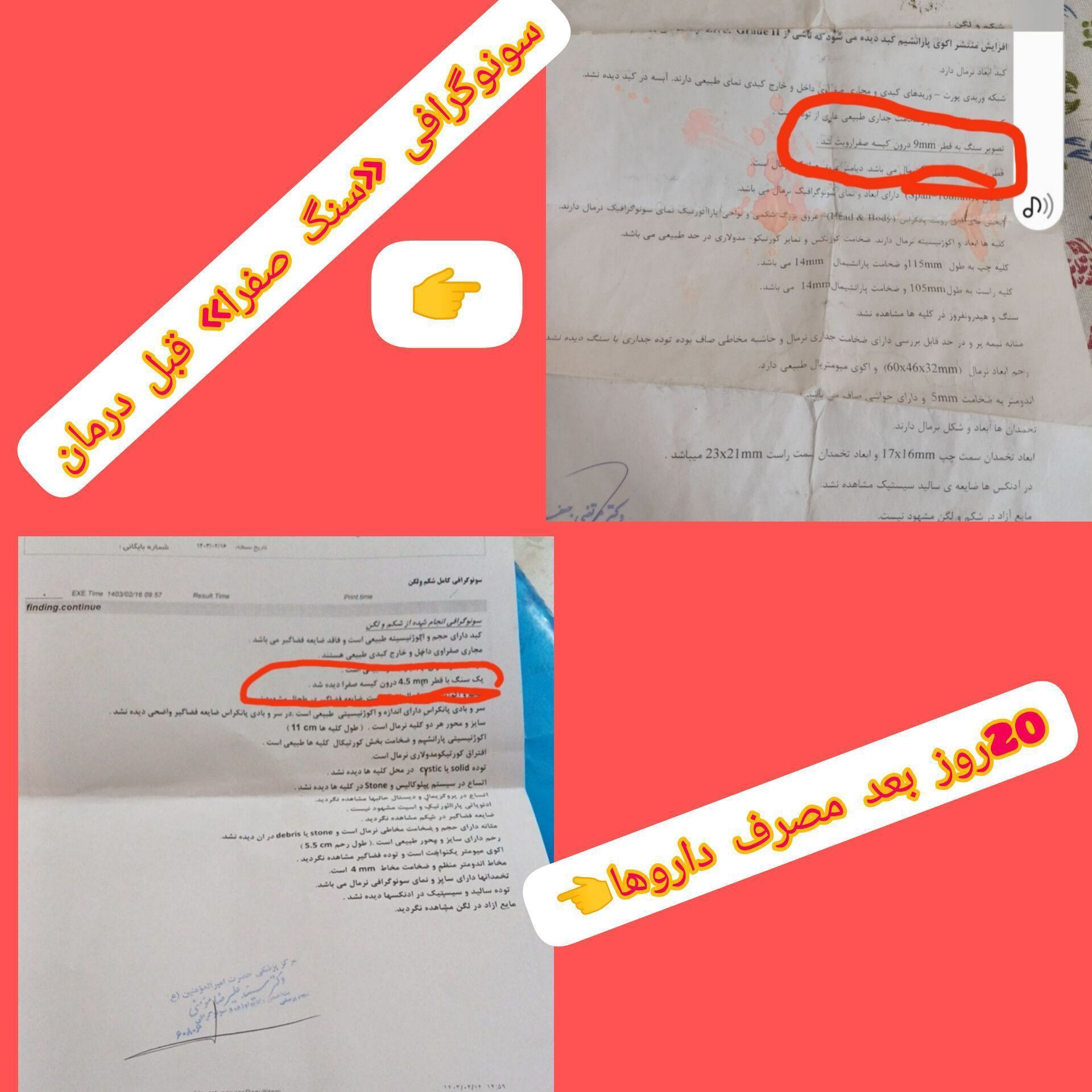 سنگ کیسه صفرا 